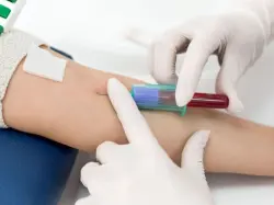 "نتائج واعدة".. اختبار دم جديد يكشف السرطان قبل ظهور الأعراض