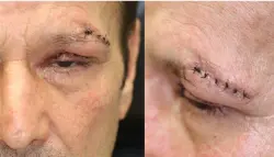 "البكتيريا آكلة اللحوم".. إصابة نادرة في العين تودي بحياة مريض وتترك آخرين يعانون من مضاعفات خطيرة