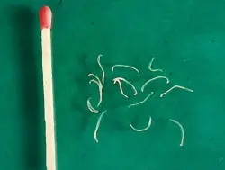 طفيليات معوية خفية.. أعراض بسيطة قد تُخفي خطرًا صحيًا كبيرًا