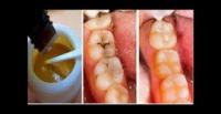 وصفات طبيعية تخلصك من تسوس الأسنان (فيديو)