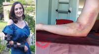 تصاب بشلل دائم بسبب تبرعها الروتيني بالدم