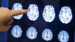 أزمة صامتة تضرب أميركا.. ارتفاع مقلق في الإعاقات الإدراكية