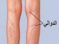 دوالي الساقين ....الأسباب والعلاج 