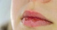 الشفاه مرآة الصحة.. علامات تحذيرية تكشف أمراضًا داخلية