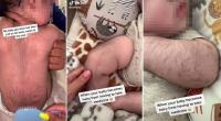 رضيع  يصبح جلده مغطى بالشعر كرجل بالغ بعد تناول دواء عقب ولادته