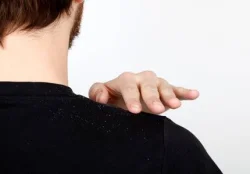ما أسباب ظهور القشرة؟