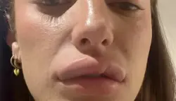 شابة تكشف معاناتها بعد إذابة فيلر الشفاه: "وجهي بدا مشوها"