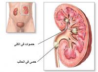 لمنع المزيد من حصى الكلى