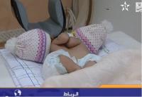 حالة ولادة نادرة لتوأم ملتصق على مستوى الصدر