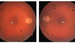 زراعة أعصاب مبتكرة تُبطئ فقدان البصر الناتج عن اضطراب ماكتيل