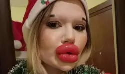 صاحبة أكبر شفاه في العالم تُمنع من العلاج.. الأطباء يرفضون لمس أسنانها!