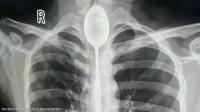 ملعقة بقيت داخل جسد رجل لمدة عام كامل