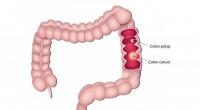 علماء يكتشفون الصلة بين البدانة وسرطان القولون