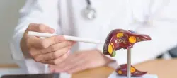 الكبد الدهني يفتح ممراً أخطر لسرطان القولون.. دراسة تكشف السبب