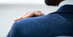 قشرة الرأس.. أسبابها وطرق طبيعية للتخلص منها نهائياً