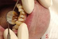 علاج أسنان المدخن الصفراء