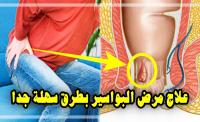 علاج مرض البواسير بطرق تقليدية وسهلة جدا في متناول الجميع