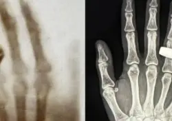 لأول مرة في الفضاء... التقاط صورة بالأشعة السينية ليد بشرية على ارتفاع 200 ميل