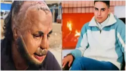 قصة تبكي الحجر.. تضامن واسع مع شاب شوه انفجار "بوطة صغيرة" وجهه وسلبته مصحة خاصة الملايين