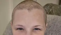 صلع وتقيؤ دموي وثقب في المريء... مأساة بريطانية بسبب حقنة تنحيف شهيرة