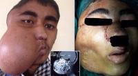 إزالة ورم من أنف شاب بحجم كرة بيسبول