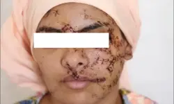 جنايات تازة تقتص لـ "ضحية التشويه"..15 سنة سجناً نافذاً في حق طليق "إيمان"