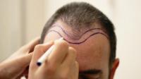 أهم معلومات عملية زراعة الشعر بتقنية السفير