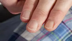 خطوط غريبة تحت الأظافر قد تُنذر بمرض قلبي خطير