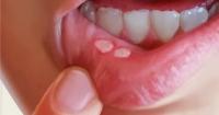 تقرحات الفم: لماذا تظهر ؟ وكيف يمكن علاجها طبيعيا؟