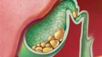 مشروب طبيعي لطرد رمال المرارة من الجسم