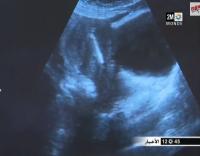 ضغط على جهاز سكانير لأمراض النساء والولادة بمراكش
