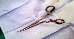 مقص جراحي في بطن مريضة يكشف إهمالاً طبياً استمر عامين