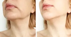 طرق طبيعية وطبية لعلاج ترهل الوجه والحفاظ على شبابه