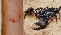 نقل سيدة إلى المستشفى بالحسيمة بعد لسعة عقرب ومطالب بتوفير الأمصال