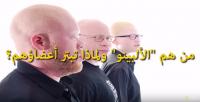 من هم "الألبينو" ولماذا تبتر أعضاؤهم؟