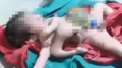 ولادة نادرة تهز الهند.. طفل يولد بـ8 أطراف ويصدم الأطباء