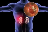 ثورة طبية.. الذكاء الاصطناعي يكشف سرطان الكلى في وقت قياسي