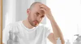بشرى سارة للرجال: علاج موضعي جديد لمشكلة الصلع يعزز نمو الشعر حتى 500%