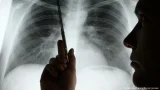 ارتفاع مقلق لعدد حالات الإصابة بسرطان الرئة بين غير المدخنين
