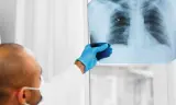 سرطان الرئة.. لماذا يصعب اكتشافه مبكراً؟ هذه علامات لا يجب تجاهلها