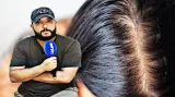 خبير يكشف الحقيقة وراء تساقط الشعر… وهذه أفضل الحلول