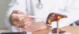 الكبد الدهني يفتح ممراً أخطر لسرطان القولون.. دراسة تكشف السبب